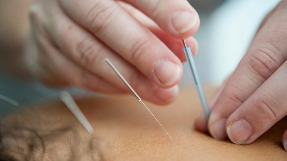 鍼の画像